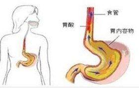 食道炎吃瓜好吗,吃瓜需谨慎，了解瓜果对食道炎的影响