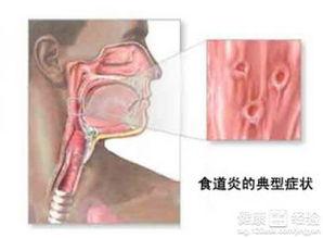 食道炎吃瓜好吗,吃瓜需谨慎，了解瓜果对食道炎的影响